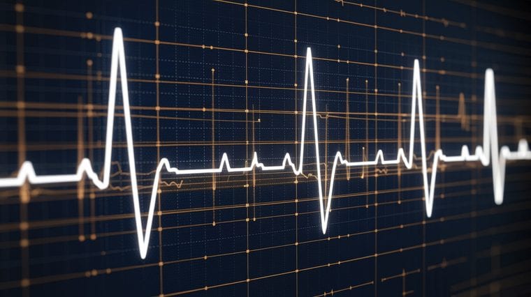 Atrial fibrillation ECG rhythm strip showing irregular heartbeat pattern