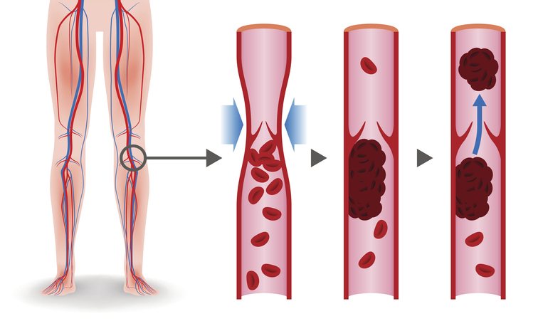 A leg vein ultrasound