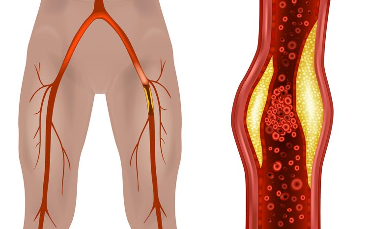 A leg artery ultrasound