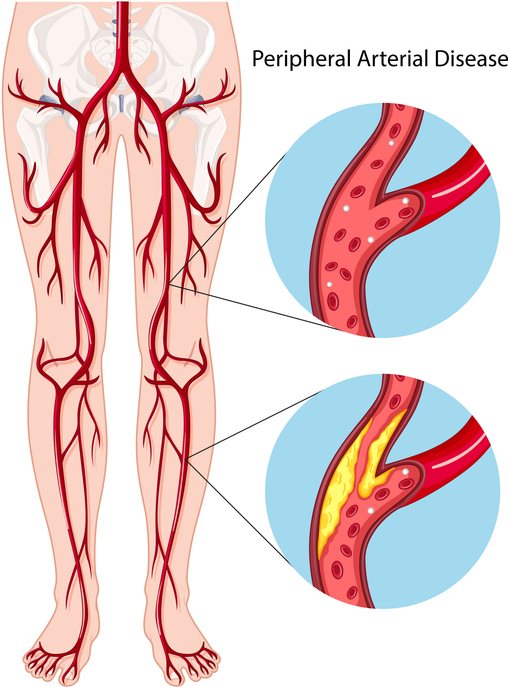 A leg artery ultrasound