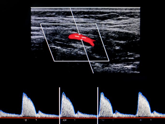 A carotid artery ultrasound of the neck