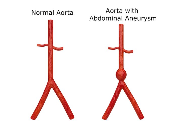 An abdominal aorta ultrasound