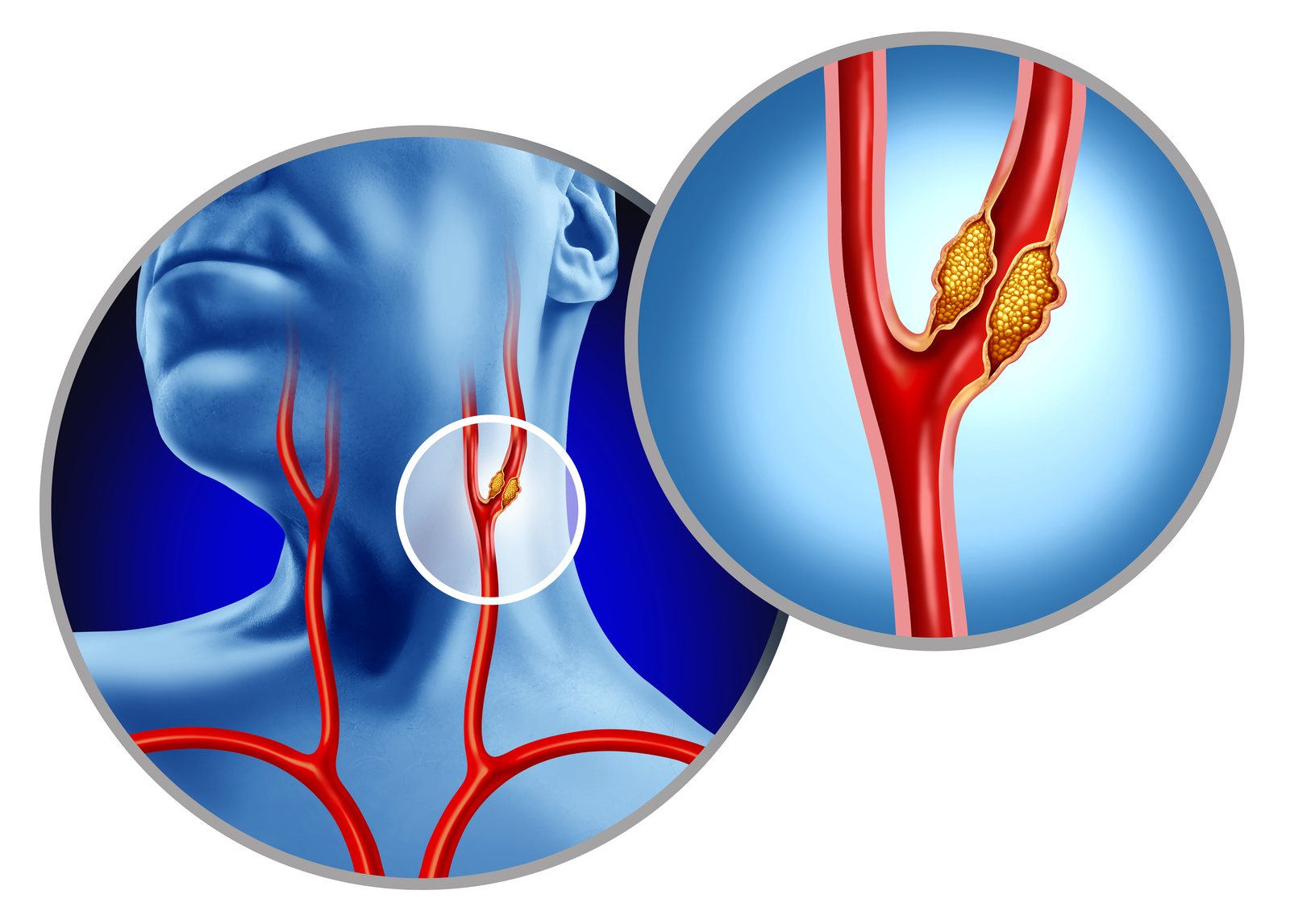 A carotid artery ultrasound of the neck