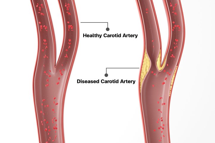 A carotid artery ultrasound of the neck