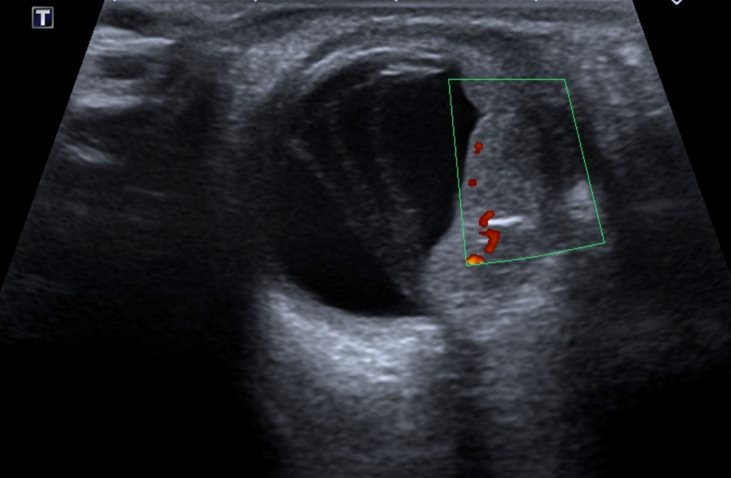 An abdominal aorta ultrasound