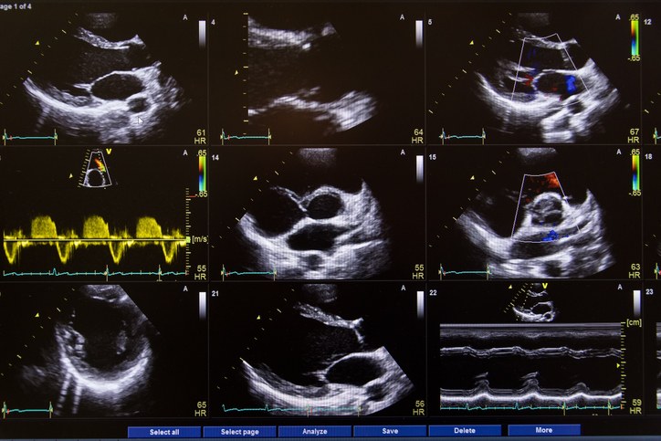Echocardiogram images on the ultrasound screen