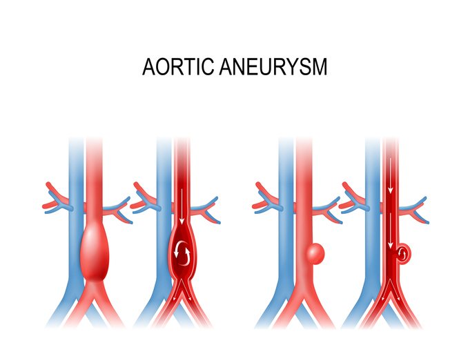 An abdominal aorta ultrasound