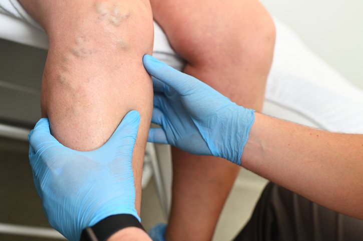A leg vein ultrasound
