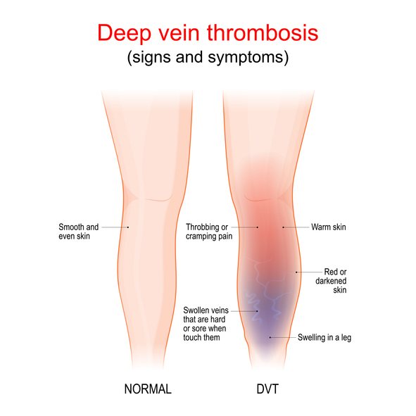 A leg vein ultrasound
