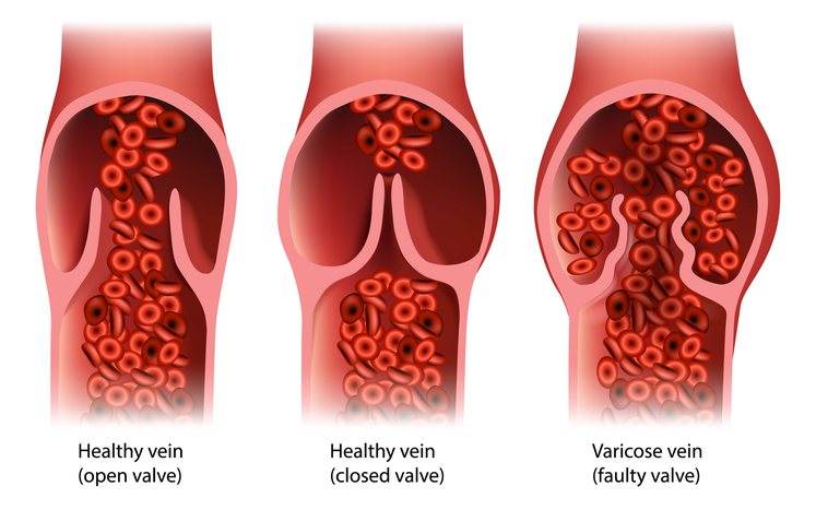 A leg vein ultrasound