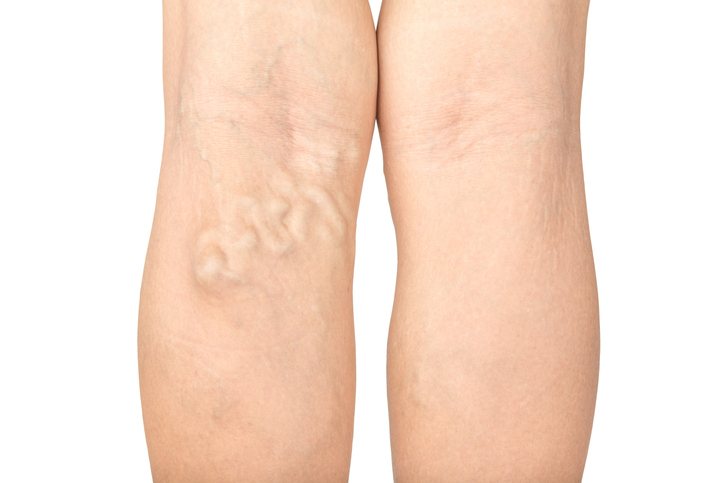 A leg vein ultrasound