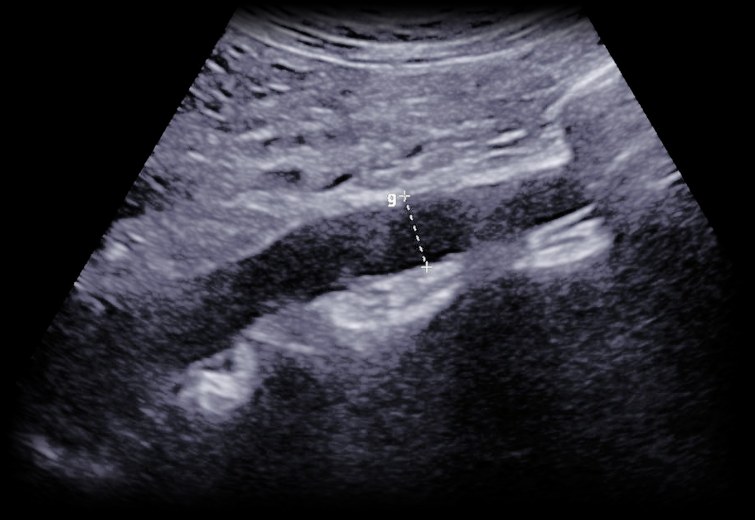 Abdominal aortic ultrasound from a BlackPoint Diagnostics study, with a caliper measurement on screen