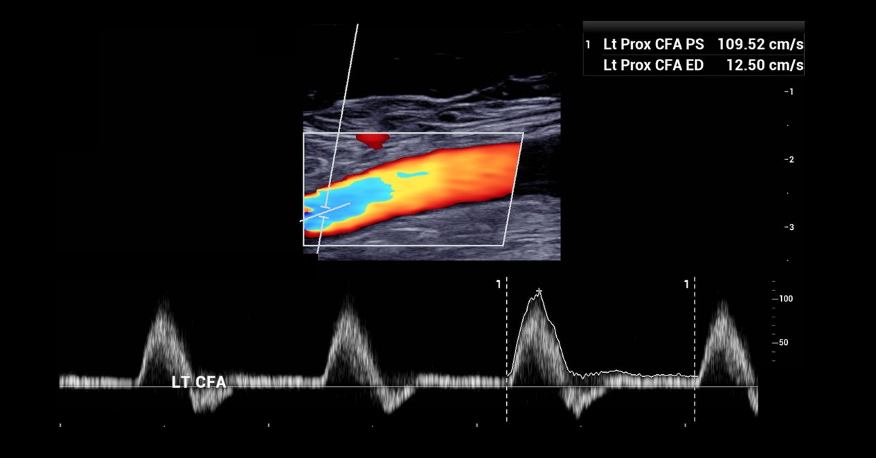 Lower extremity arterial duplex ultrasound from a BlackPoint Diagnostics study, showing colour flow in the artery above and its Doppler waveform below