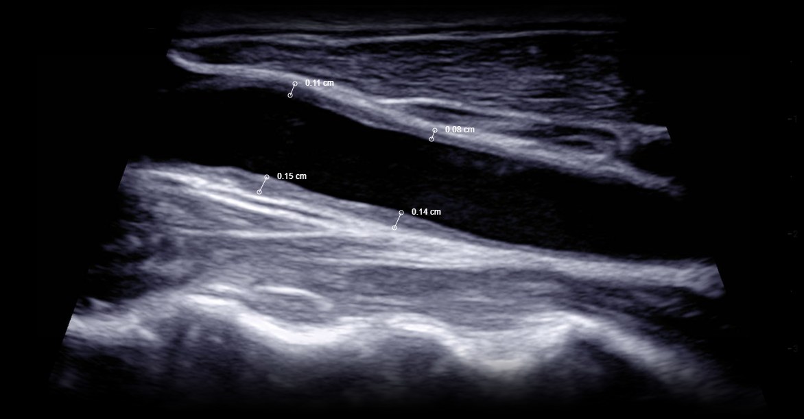 Carotid duplex ultrasound from a BlackPoint Diagnostics study, with four caliper measurements shown on screen