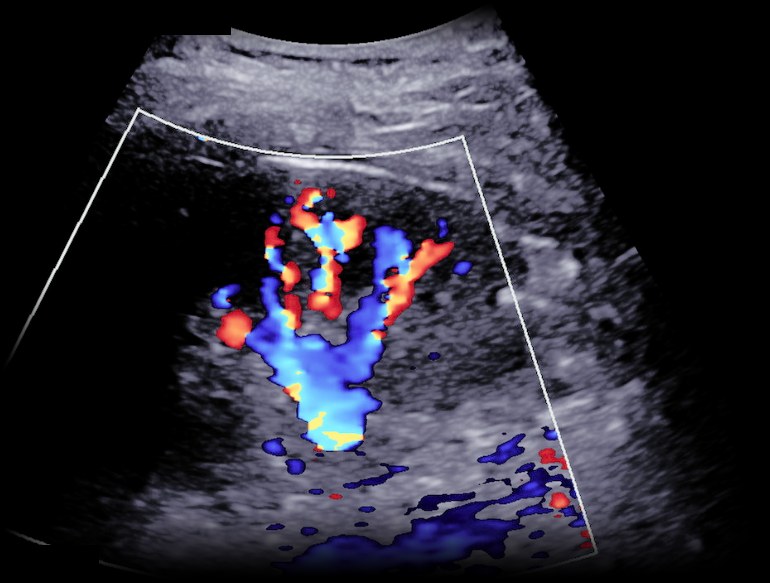 Renal artery colour Doppler ultrasound from a BlackPoint Diagnostics study, showing blood flow in the vessels of the kidney