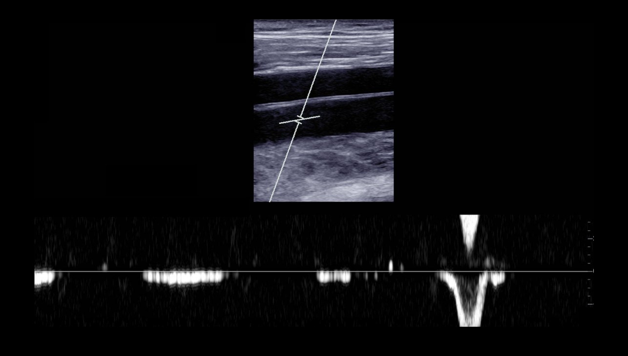 Lower extremity venous duplex ultrasound from a BlackPoint Diagnostics study, showing the vein above and its Doppler waveform below